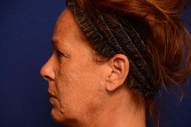 Upper Blepharoplasty Before & After Gallery - Patient 121717 - Image 3