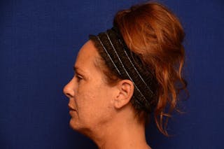 Upper Blepharoplasty Before & After Gallery - Patient 121717 - Image 4