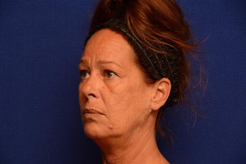 Upper Blepharoplasty Before & After Gallery - Patient 121717 - Image 5