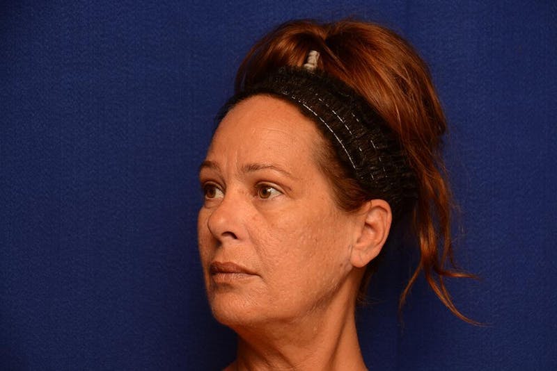 Upper Blepharoplasty Before & After Gallery - Patient 121717 - Image 6