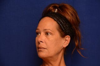 Upper Blepharoplasty Before & After Gallery - Patient 121717 - Image 6