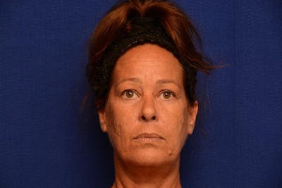 Upper Blepharoplasty Before & After Gallery - Patient 121717 - Image 1