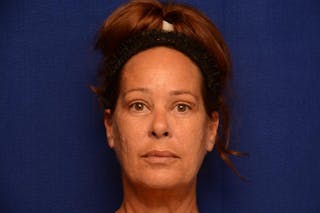 Upper Blepharoplasty Before & After Gallery - Patient 121717 - Image 2