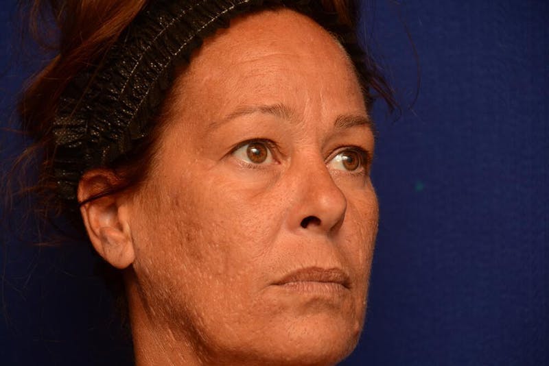 Upper Blepharoplasty Before & After Gallery - Patient 121717 - Image 7