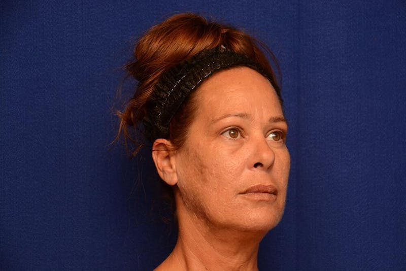 Upper Blepharoplasty Before & After Gallery - Patient 121717 - Image 8