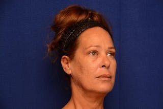 Upper Blepharoplasty Before & After Gallery - Patient 121717 - Image 8