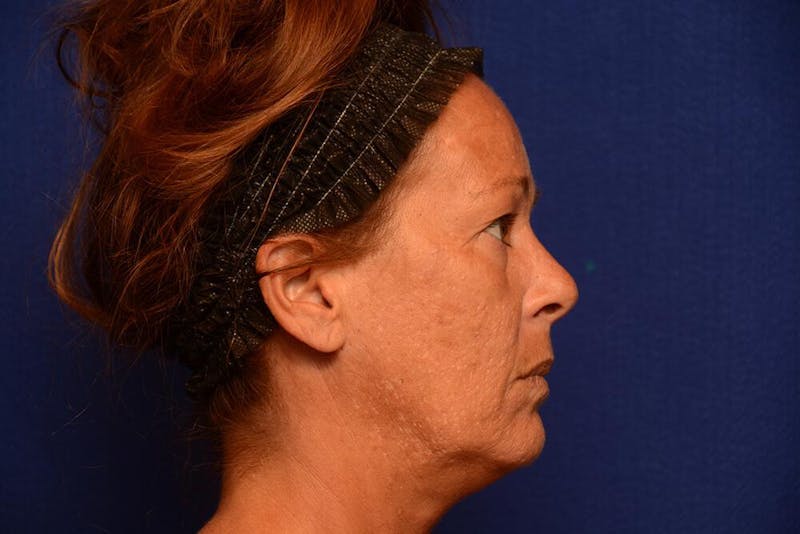 Upper Blepharoplasty Before & After Gallery - Patient 121717 - Image 9