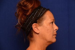 Upper Blepharoplasty Before & After Gallery - Patient 121717 - Image 10