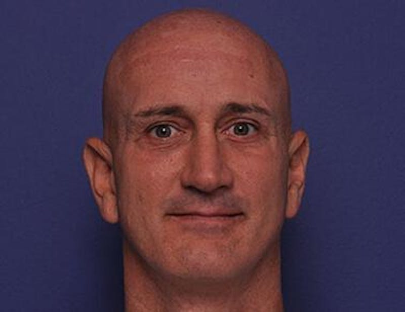 Upper Blepharoplasty Before & After Gallery - Patient 110786 - Image 2