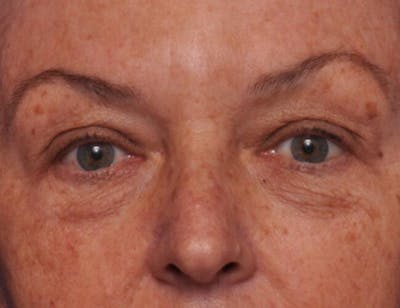 Upper Blepharoplasty Before & After Gallery - Patient 398291 - Image 1