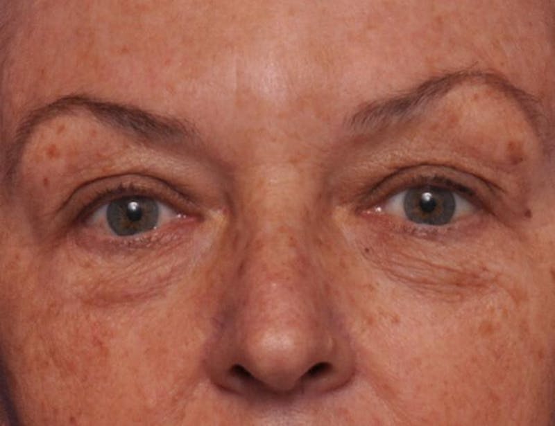 Upper Blepharoplasty Before & After Gallery - Patient 398291 - Image 1