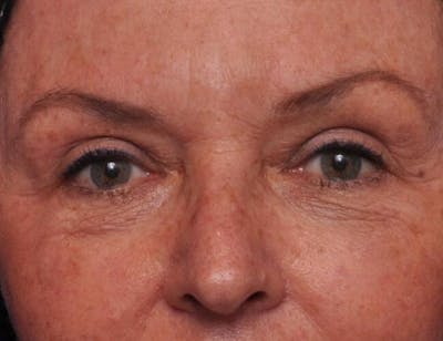 Upper Blepharoplasty Before & After Gallery - Patient 398291 - Image 2