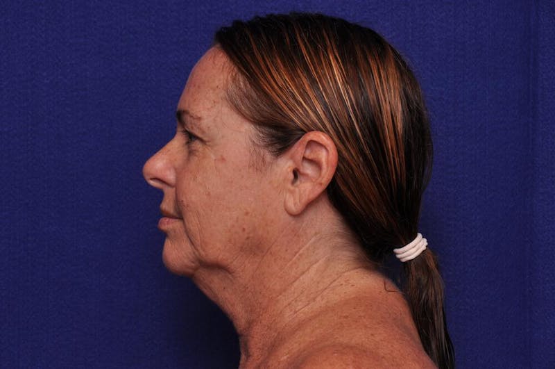 Upper Blepharoplasty Before & After Gallery - Patient 569191 - Image 3