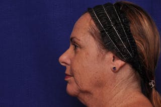 Upper Blepharoplasty Before & After Gallery - Patient 569191 - Image 4