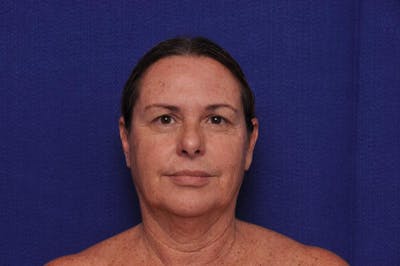 Upper Blepharoplasty Before & After Gallery - Patient 569191 - Image 1