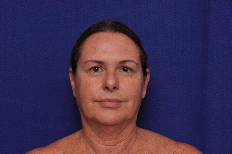 Upper Blepharoplasty Before & After Gallery - Patient 569191 - Image 1
