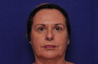 Upper Blepharoplasty Before & After Gallery - Patient 569191 - Image 2