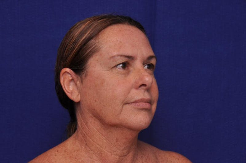Upper Blepharoplasty Before & After Gallery - Patient 569191 - Image 5