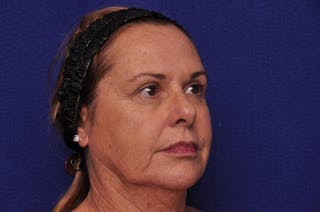 Upper Blepharoplasty Before & After Gallery - Patient 569191 - Image 6