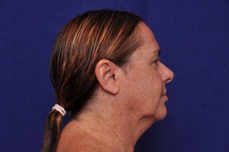 Upper Blepharoplasty Before & After Gallery - Patient 569191 - Image 7