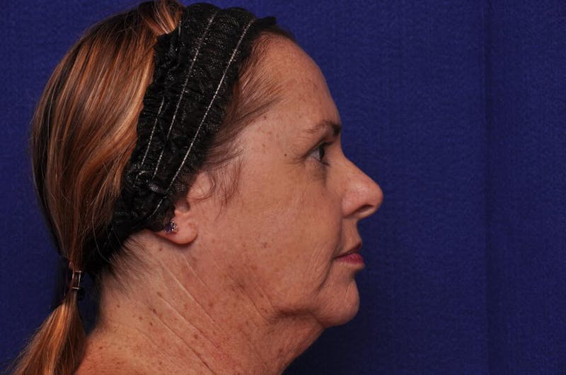 Upper Blepharoplasty Before & After Gallery - Patient 569191 - Image 8