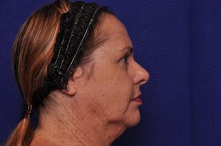 Upper Blepharoplasty Before & After Gallery - Patient 569191 - Image 8