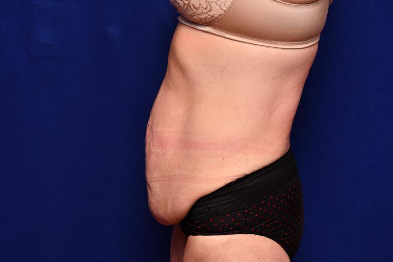 After Massive Weight Loss Before & After Gallery - Patient 102762 - Image 1