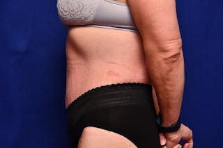 After Massive Weight Loss Before & After Gallery - Patient 102762 - Image 2