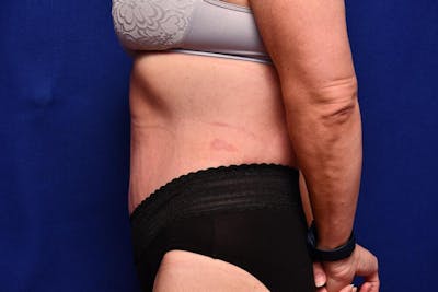 After Massive Weight Loss Before & After Gallery - Patient 102762 - Image 2