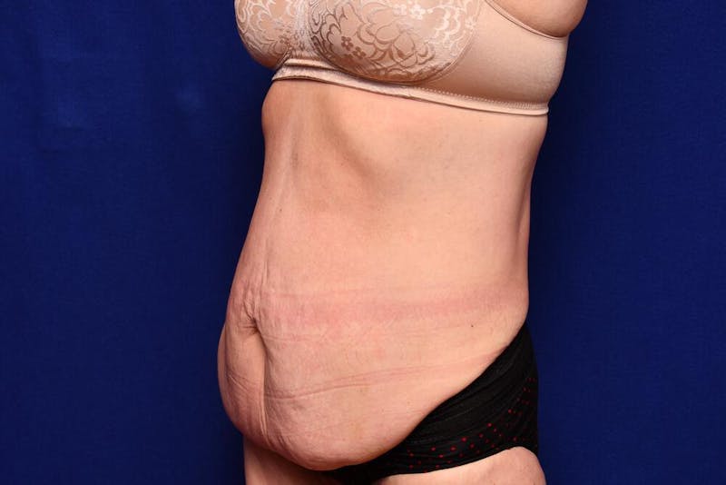 After Massive Weight Loss Before & After Gallery - Patient 102762 - Image 3