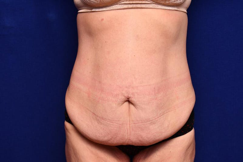 After Massive Weight Loss Before & After Gallery - Patient 102762 - Image 5