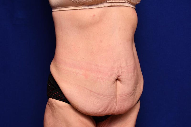 After Massive Weight Loss Before & After Gallery - Patient 102762 - Image 7