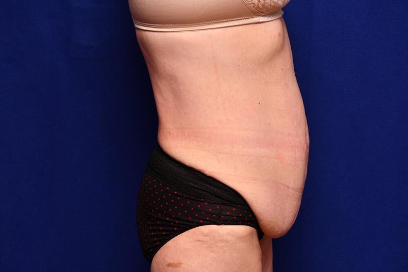 After Massive Weight Loss Before & After Gallery - Patient 102762 - Image 9