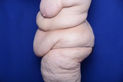 After Massive Weight Loss Before & After Gallery - Patient 249473 - Image 1