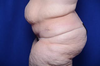 After Massive Weight Loss Before & After Gallery - Patient 249473 - Image 2