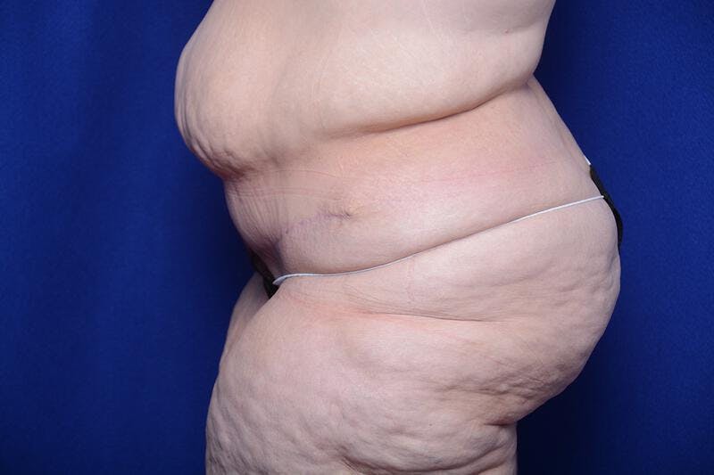 After Massive Weight Loss Before & After Gallery - Patient 249473 - Image 2