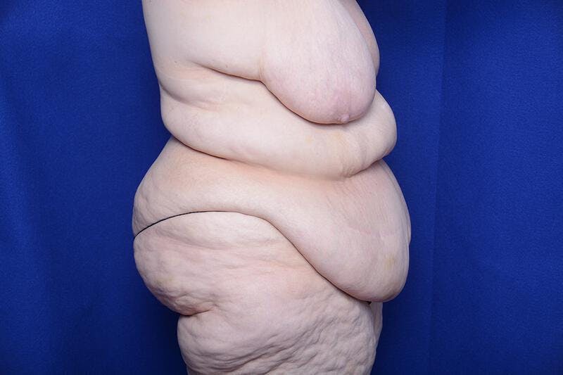 After Massive Weight Loss Before & After Gallery - Patient 249473 - Image 3