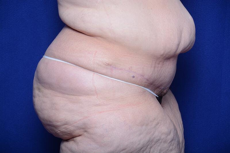 After Massive Weight Loss Before & After Gallery - Patient 249473 - Image 4
