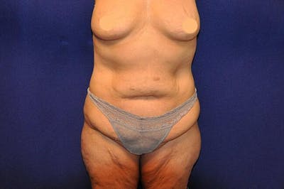 After Massive Weight Loss Before & After Gallery - Patient 193005 - Image 1