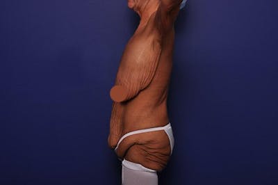 After Massive Weight Loss Before & After Gallery - Patient 240117 - Image 1