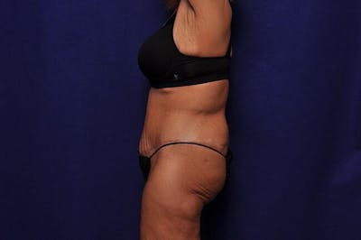After Massive Weight Loss Before & After Gallery - Patient 240117 - Image 2