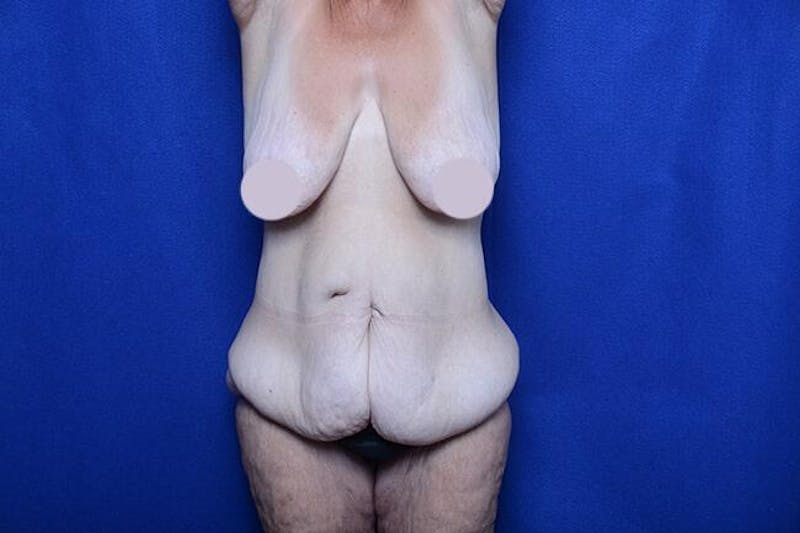 After Massive Weight Loss Before & After Gallery - Patient 292484 - Image 1