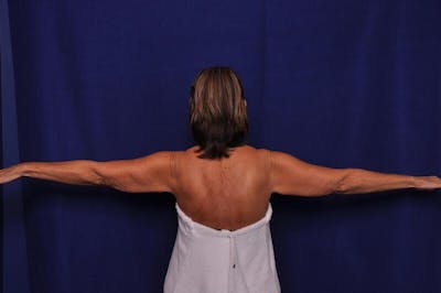 Arm Lift Before & After Gallery - Patient 309025 - Image 1