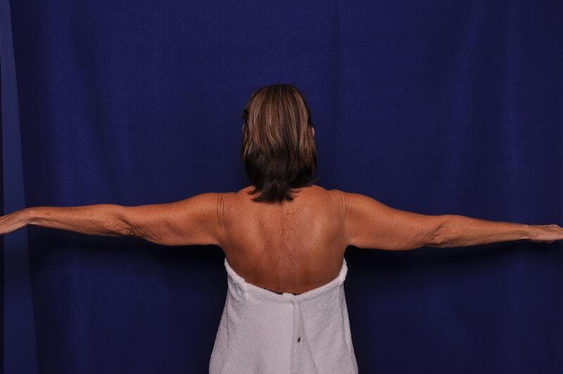 Arm Lift Before & After Gallery - Patient 309025 - Image 1