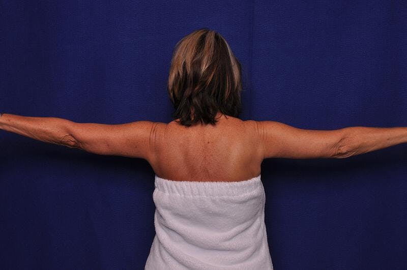 Arm Lift Before & After Gallery - Patient 309025 - Image 2