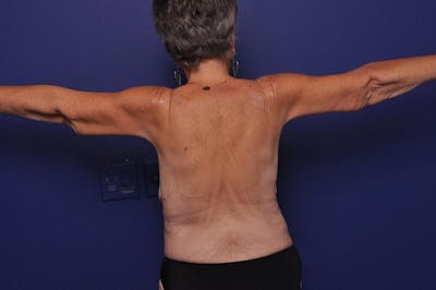 Arm Lift Before & After Gallery - Patient 206075 - Image 1