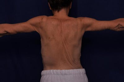Arm Lift Before & After Gallery - Patient 206075 - Image 2