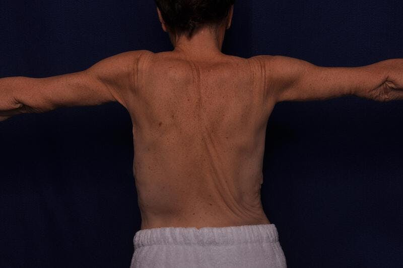 Arm Lift Before & After Gallery - Patient 206075 - Image 2