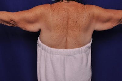 Arm Lift Before & After Gallery - Patient 302270 - Image 1