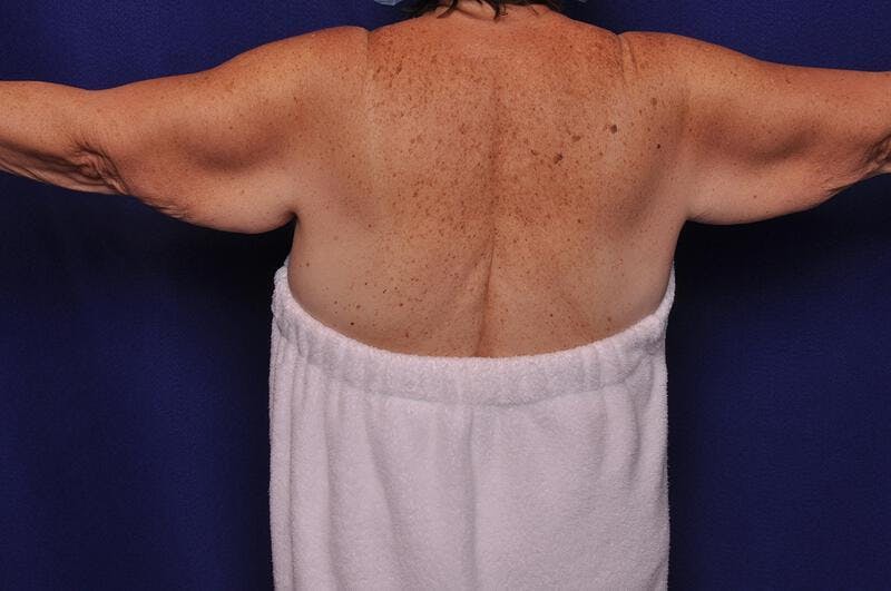 Arm Lift Before & After Gallery - Patient 302270 - Image 1
